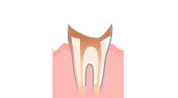 歯根まで進行した虫歯（C4）
