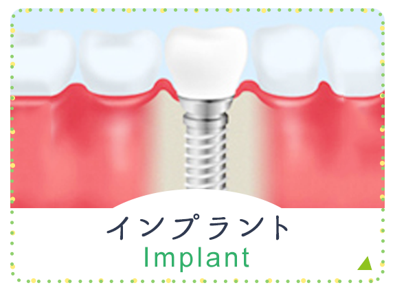 インプラント